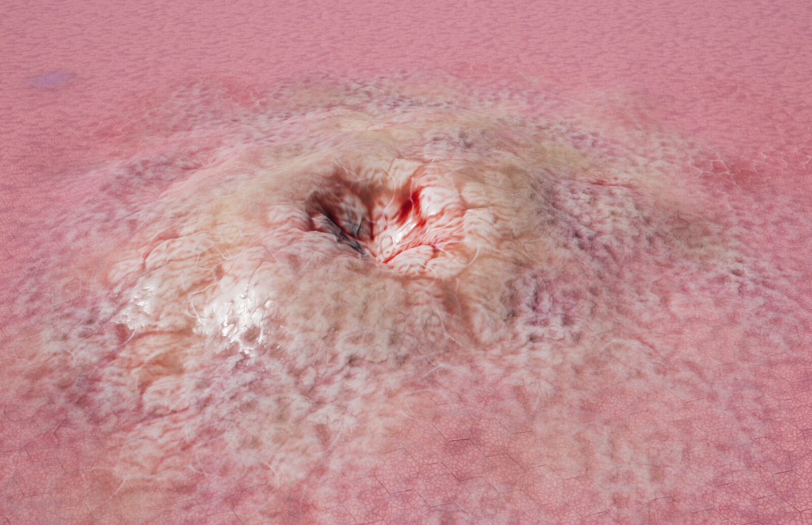 Lesion